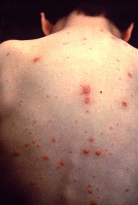 varicella zoster infection icd 10